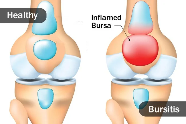 Bursitis