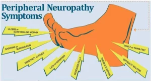 Neuropathy