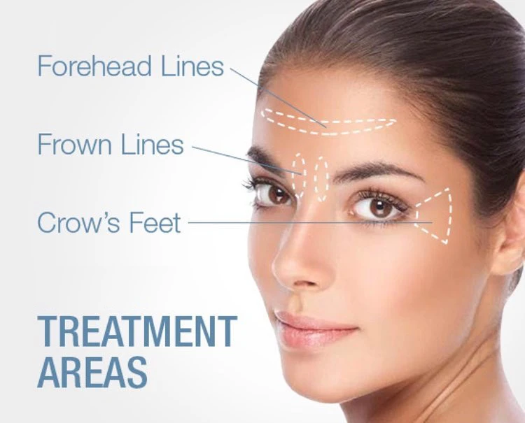 Treatment areas on face