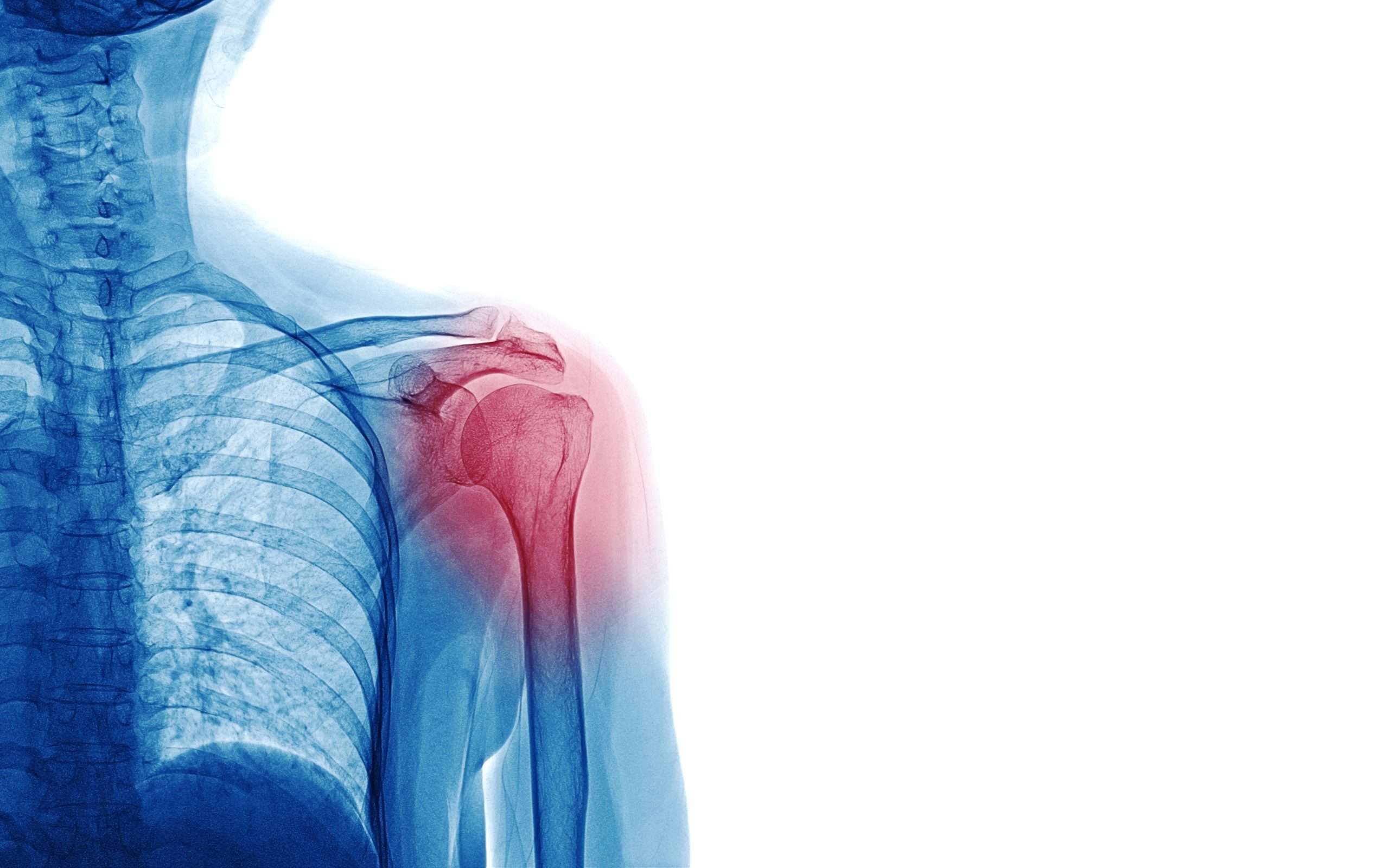 How long does it take for a torn rotator cuff to heal without surgery? -  shoulder clinic Hyderabad