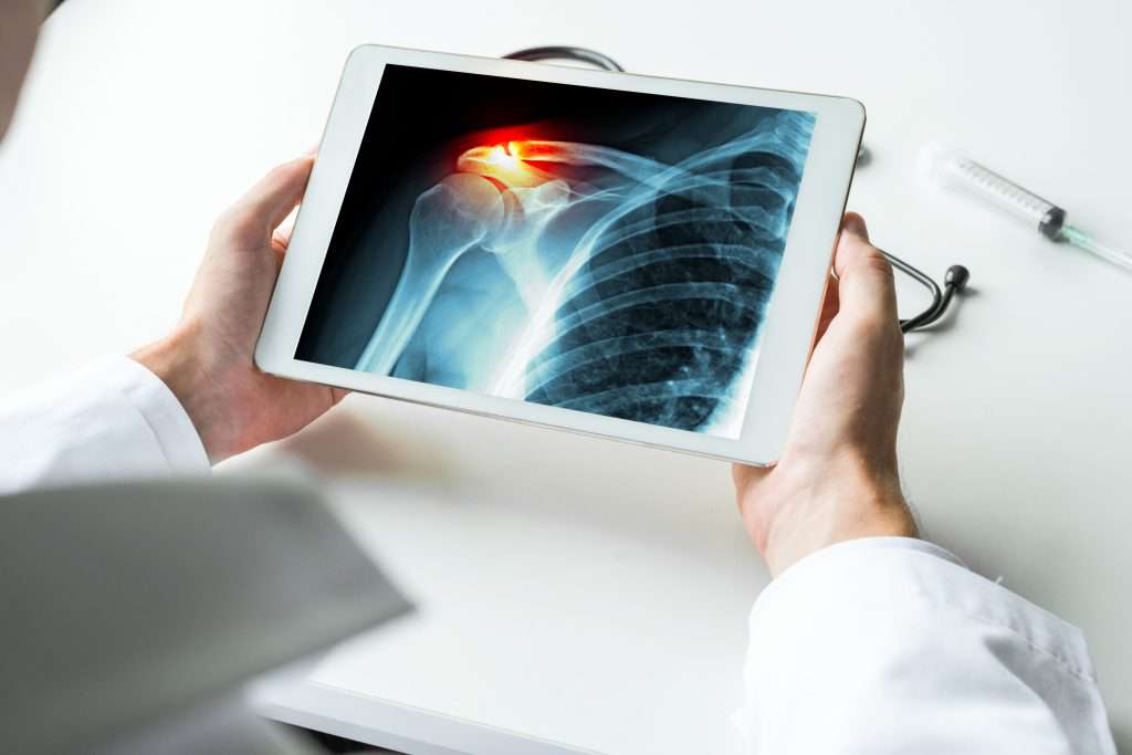 Will my rotator cuff heal without surgery? Avoid Surgery Stem Cells
