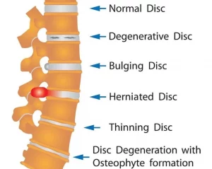 Herniated Disc