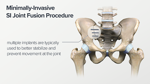 SI joint Fusion