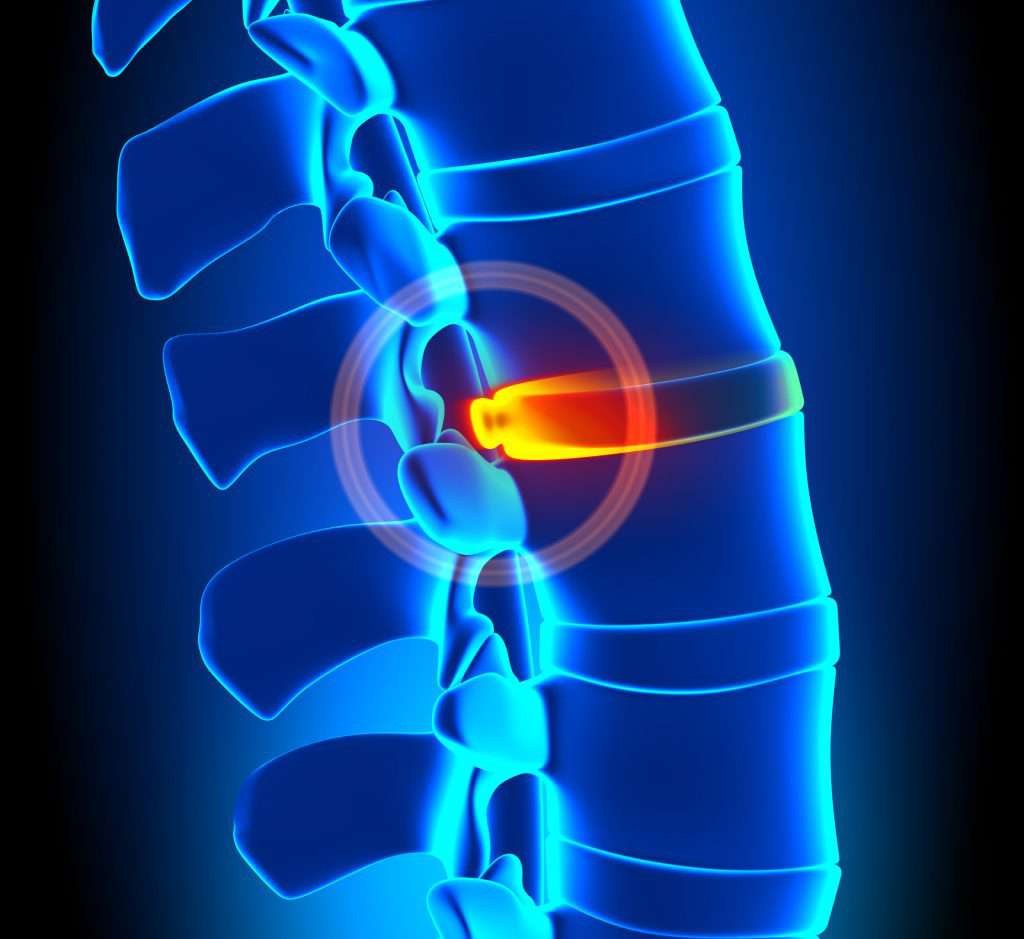 Bulging Disc Degeneration