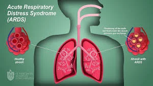 Respiratory Distress