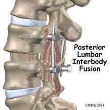 posterior lumbar interbody fusion