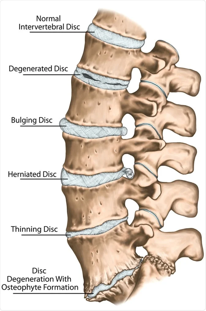 Disc degeneration