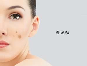 Melasma