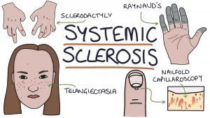 Systemic Sclerosis