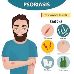 psoriasis