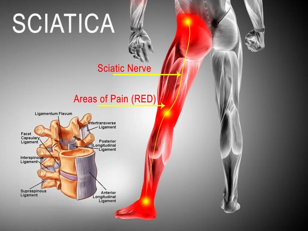 Sciatica - Regen Doctors