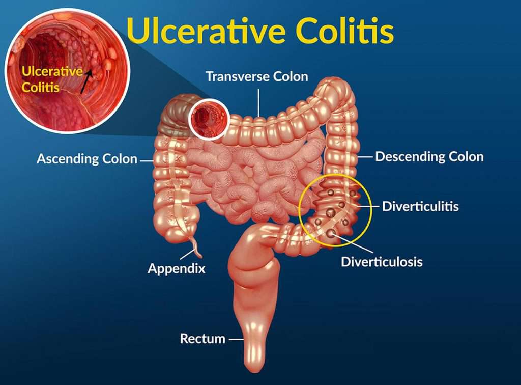Ulcerative Colitis Treatment ulcerative-colitis-diet-food-list