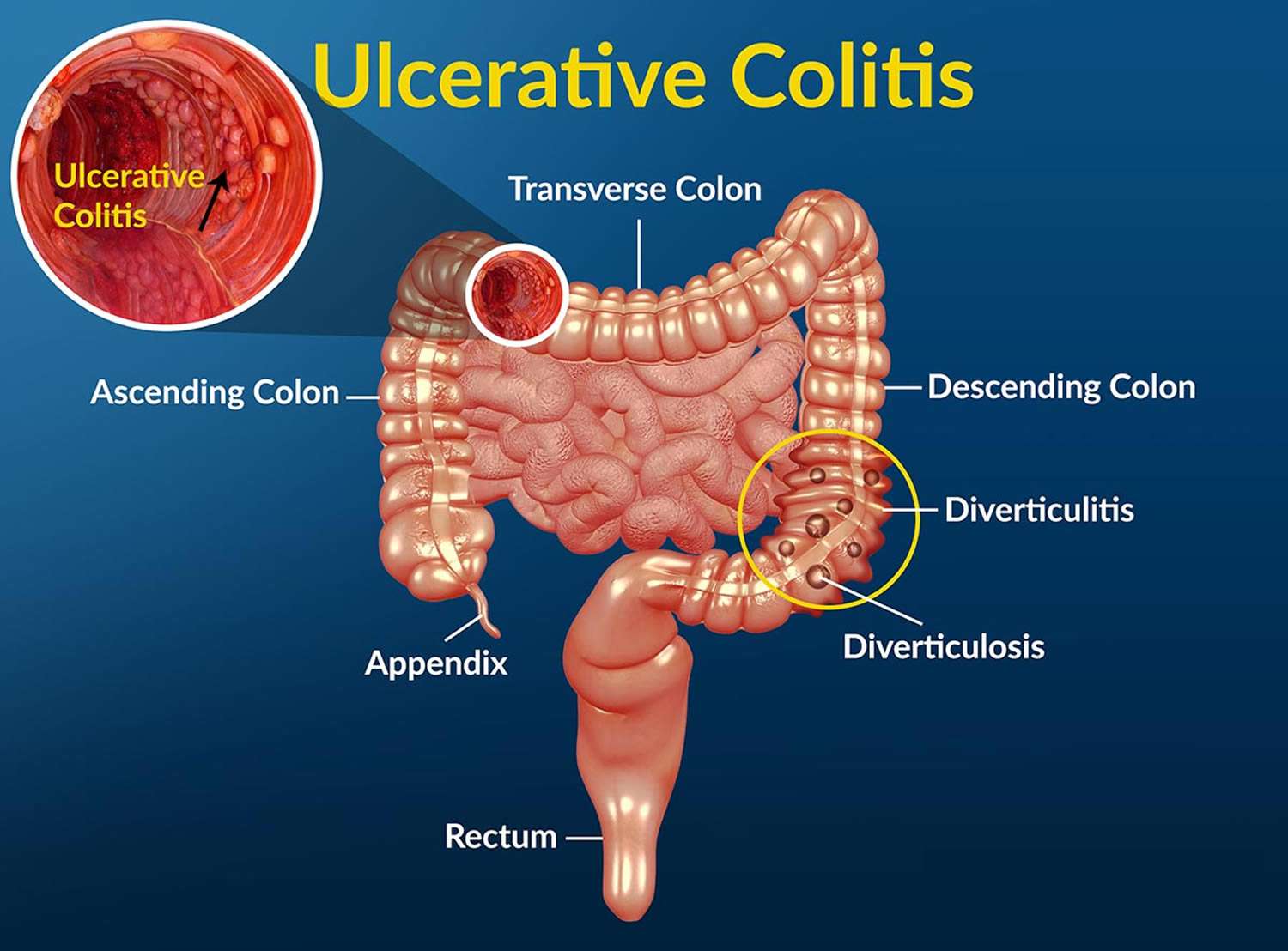 Clinical Challenge: Long-term Concerns in Ulcerative Colitis