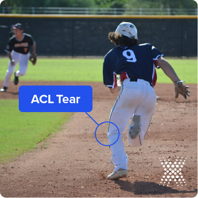 An ACL tear is a common baseball injury which affects the knee area.