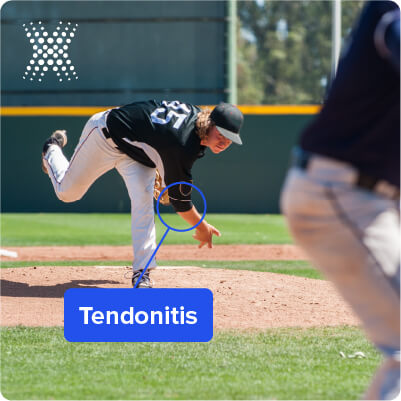 Tendonitis is another common baseball injury that typically affects the area of the elbow, the rotary cuff or the shoulder.