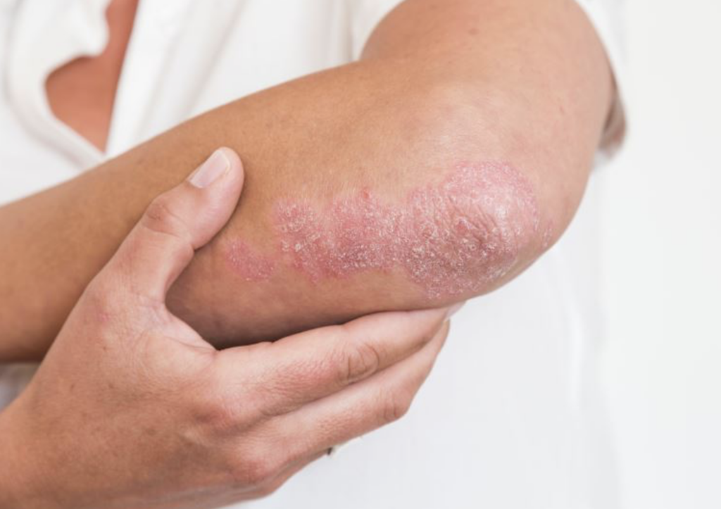 Psoriasis usually appears in early adulthood. For many people, it affects just a few areas. In severe cases, psoriasis can cover large parts of the body. 